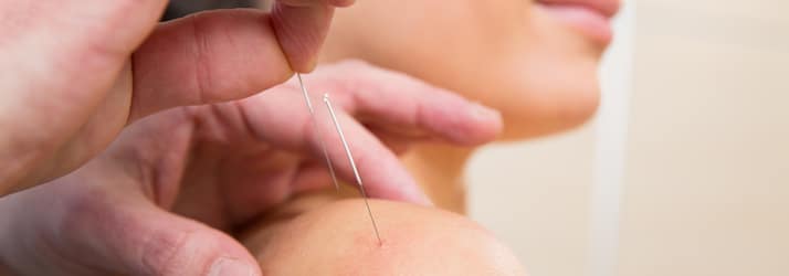 Dry needling at the shoulder